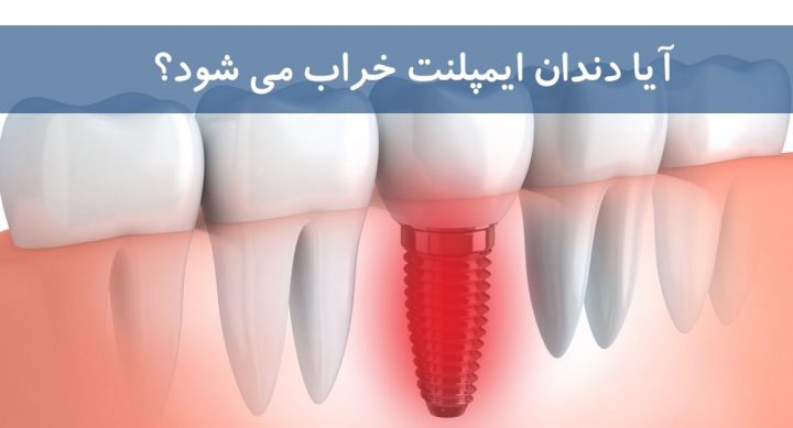 تعویض ایمپلنت دندان