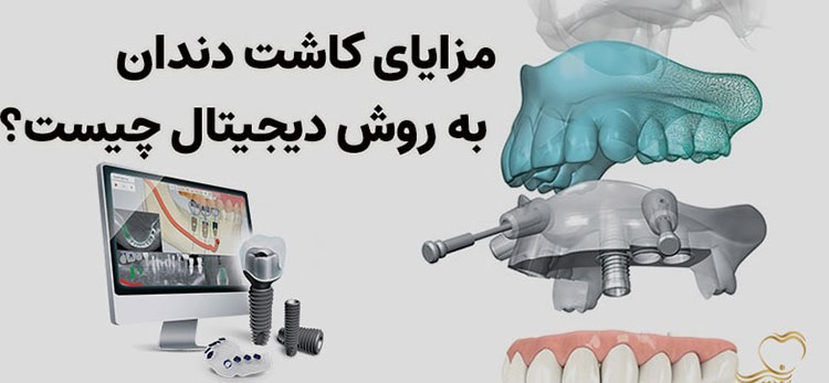 ایمپلنت دیجیتال