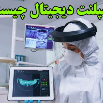 ایمپلنت دیجیتال