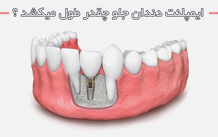 زمان نصب ایمپلنت دندان چقدر طول می کشد؟ 