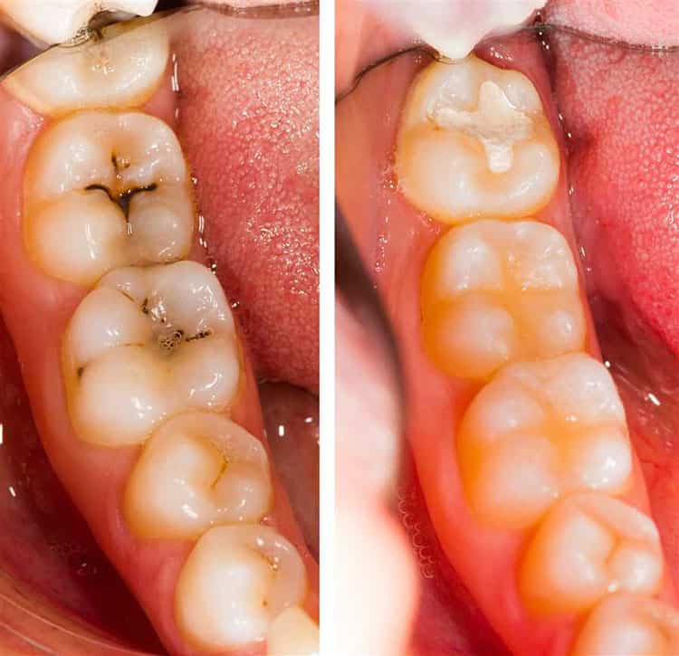 قیمت کامپوزیت دتدان