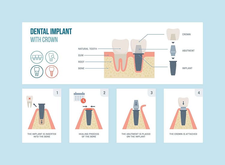 مراحل ایمپلنت دندان
