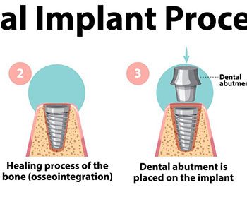 مراحل ایمپلنت دندان