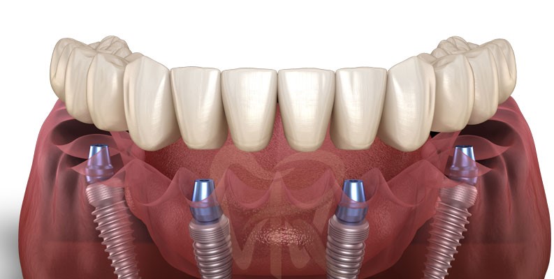 کاشت دندان به روش all-on-4