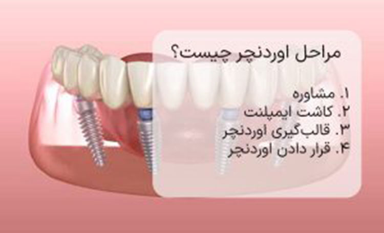 قیمت اوردنچر ایمپلنت