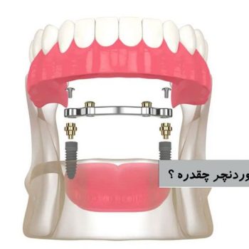 قیمت اوردنچر ایمپلنت