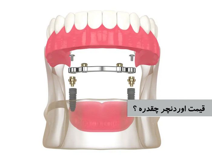 قیمت اوردنچر ایمپلنت