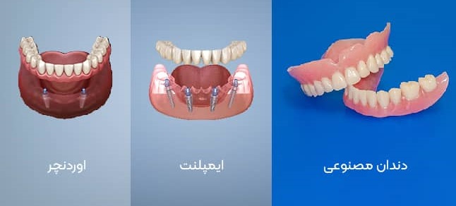 قیمت اوردنچر ایمپلنت