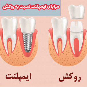 نصب روکش ایمپلنت