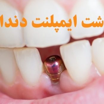 قیمت کاشت دندان طبیعی