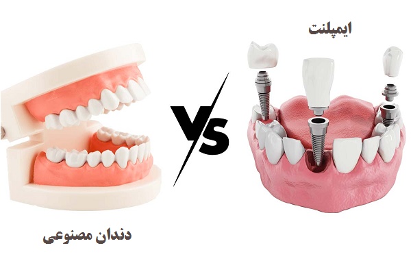 ایمپلنت یا دندان مصنوعی