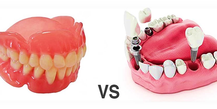 ایمپلنت یا دندان مصنوعی