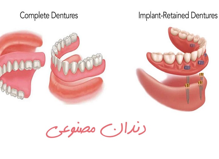 ایمپلنت یا دندان مصنوعی