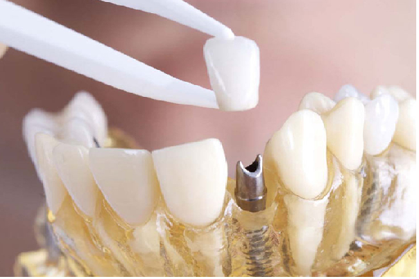 قیمت تاج دندان ایمپلنت