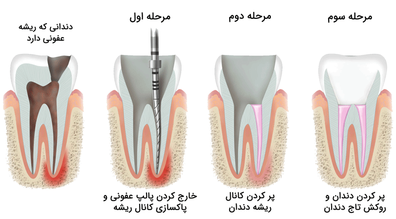 درمان ریشه دندان