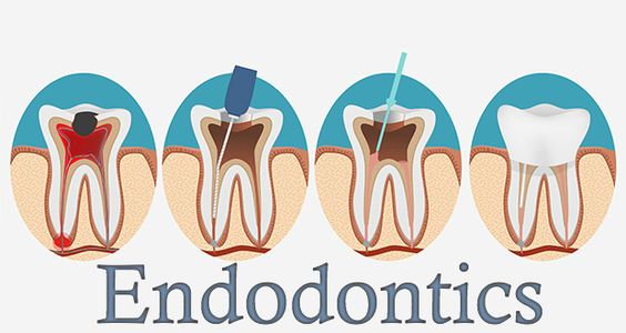درمان ریشه دندان