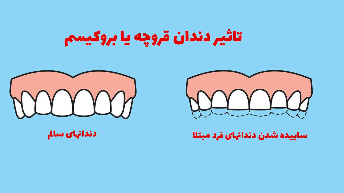 دندان قروچه