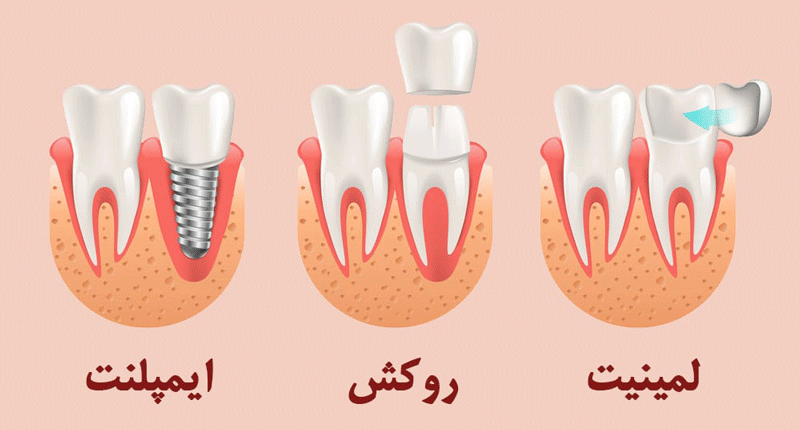 قیمت بهترین روکش دندان