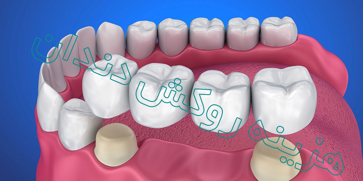 قیمت بهترین روکش دندان