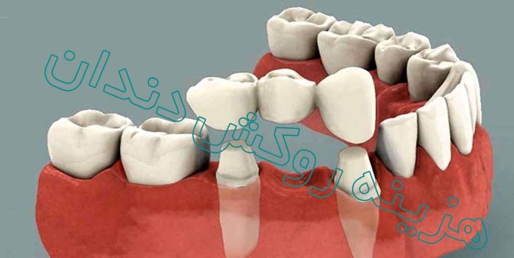 قیمت بهترین روکش دندان