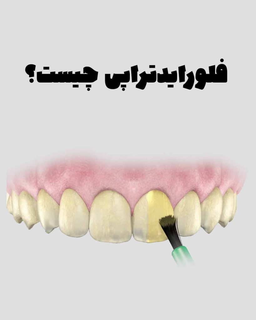 فلورایدتراپی دندان