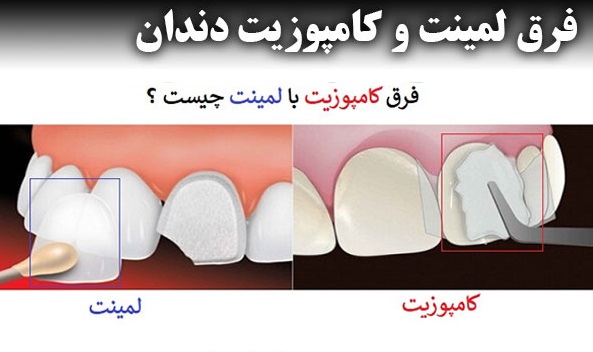 فرق لمینت و کامپوزیت دندان