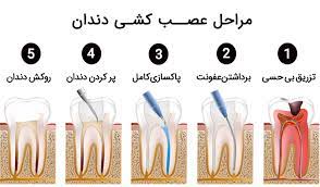 مراحل عصب کشی دندان