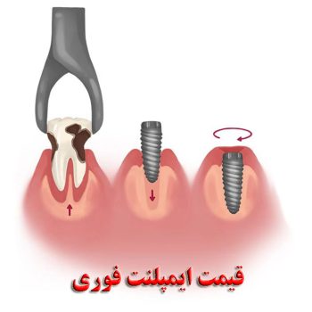 قیمت ایمپلنت فوری